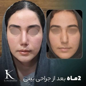 1_rhinoplasty-42