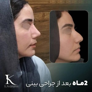 1_rhinoplasty-43