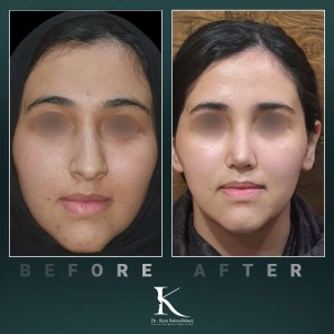 1_rhinoplasty-61