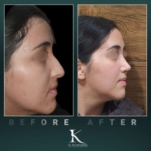 1_rhinoplasty-62