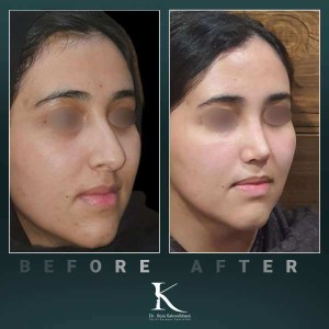 1_rhinoplasty-63