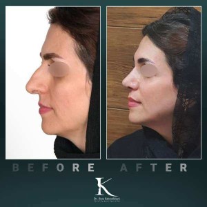 1_rhinoplasty-69