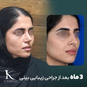 rhinoplasty-10