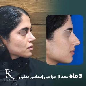 rhinoplasty-11