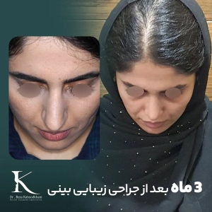 rhinoplasty-12