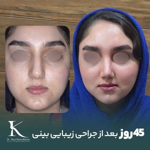 rhinoplasty-13