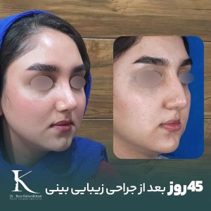 rhinoplasty-14