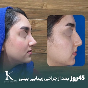 rhinoplasty-15