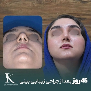 rhinoplasty-16