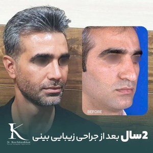 rhinoplasty-17