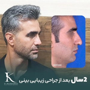 rhinoplasty-18