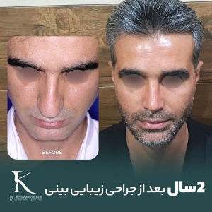 rhinoplasty-19
