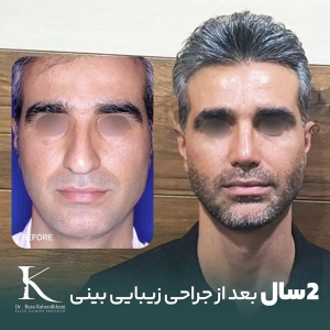 rhinoplasty-20