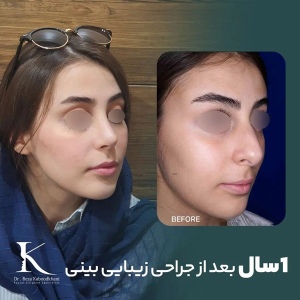 rhinoplasty-21