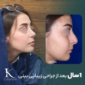 rhinoplasty-22