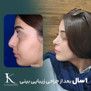 rhinoplasty-23
