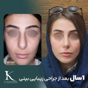 rhinoplasty-24