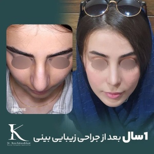 rhinoplasty-25