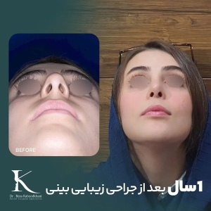 rhinoplasty-26