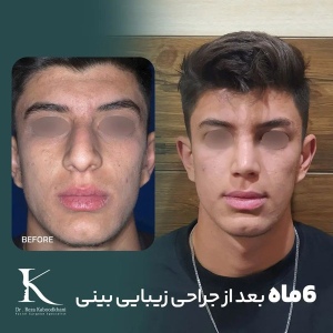 rhinoplasty-27