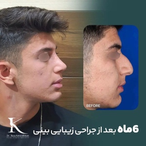 rhinoplasty-28