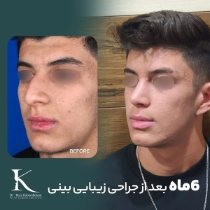 rhinoplasty-29