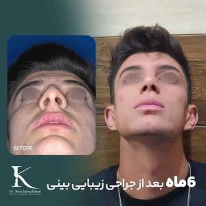 rhinoplasty-30