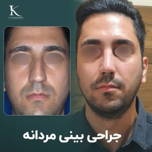 rhinoplasty-31