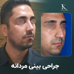 rhinoplasty-32