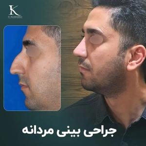 rhinoplasty-33