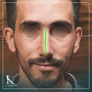 rhinoplasty-34