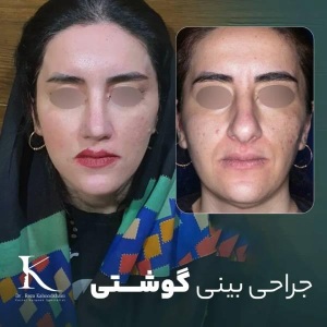rhinoplasty-35