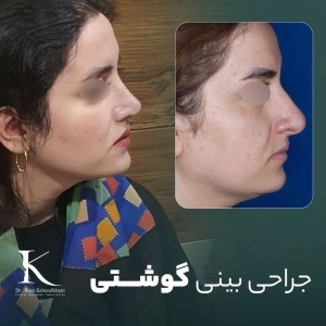rhinoplasty-36
