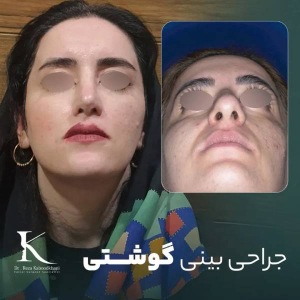 rhinoplasty-37