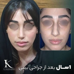 rhinoplasty-38