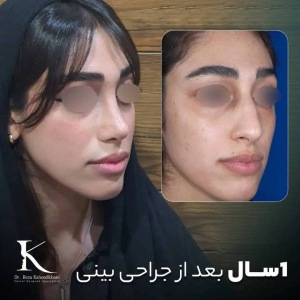 rhinoplasty-39
