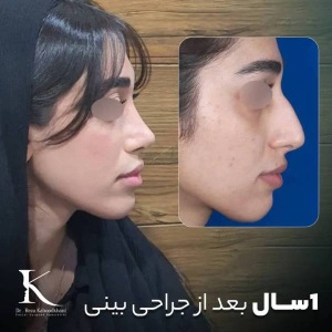 rhinoplasty-40