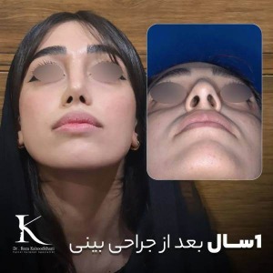 rhinoplasty-41