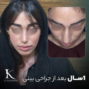 rhinoplasty-42