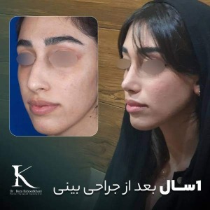 rhinoplasty-43
