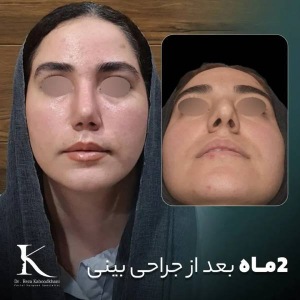 rhinoplasty-44