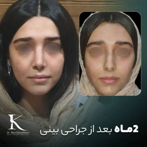 rhinoplasty-45