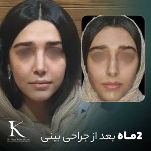 rhinoplasty-46