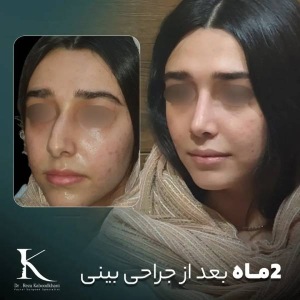 rhinoplasty-47