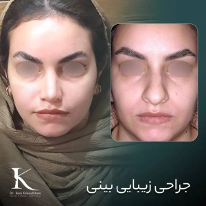 rhinoplasty-48