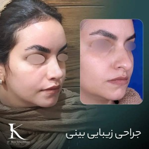 rhinoplasty-49