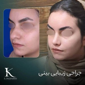 rhinoplasty-50