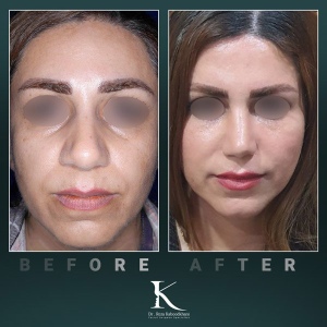 rhinoplasty-51