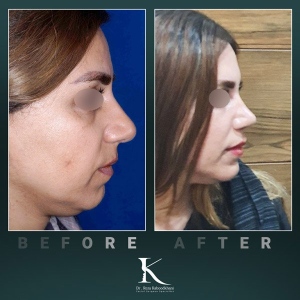 rhinoplasty-52