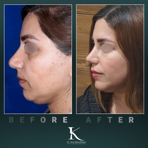 rhinoplasty-53